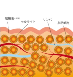 脂肪細胞にセルライトが付着しているイラスト